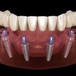 How To Remove Tartar And Plaque From Your Teeth Without A Dentist?