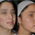 How Long Will My Laser Skin Resurfacing Results Last?