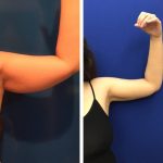 How to Prepare For Your First Liposuction