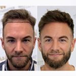 Rediscover Confidence with Advanced Hair Restoration Solutions